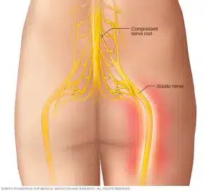 תמונה של סכיאטיקה, כאב נוירופתי