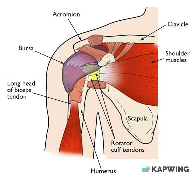 קרע בכתף,ברוסיטיס