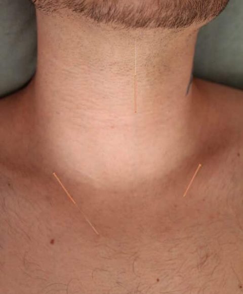 דיקור (2)_800x533