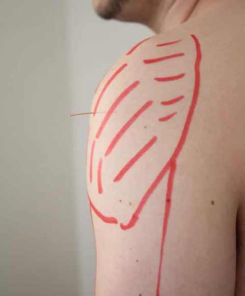 כתף טיפול_533x800